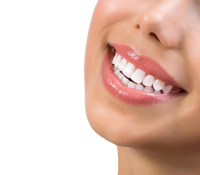 Woman with white teeth smiling, lakeland fl