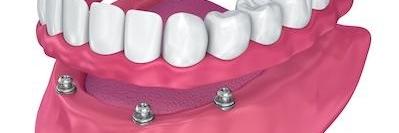 close up model of implant supported dentures l implant supported dentures lakeland fl
