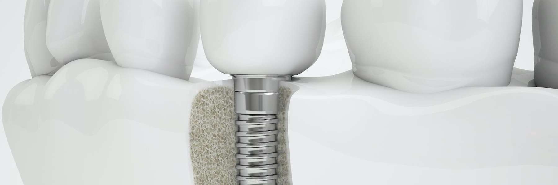 Dental implant single tooth example, lakeland fl