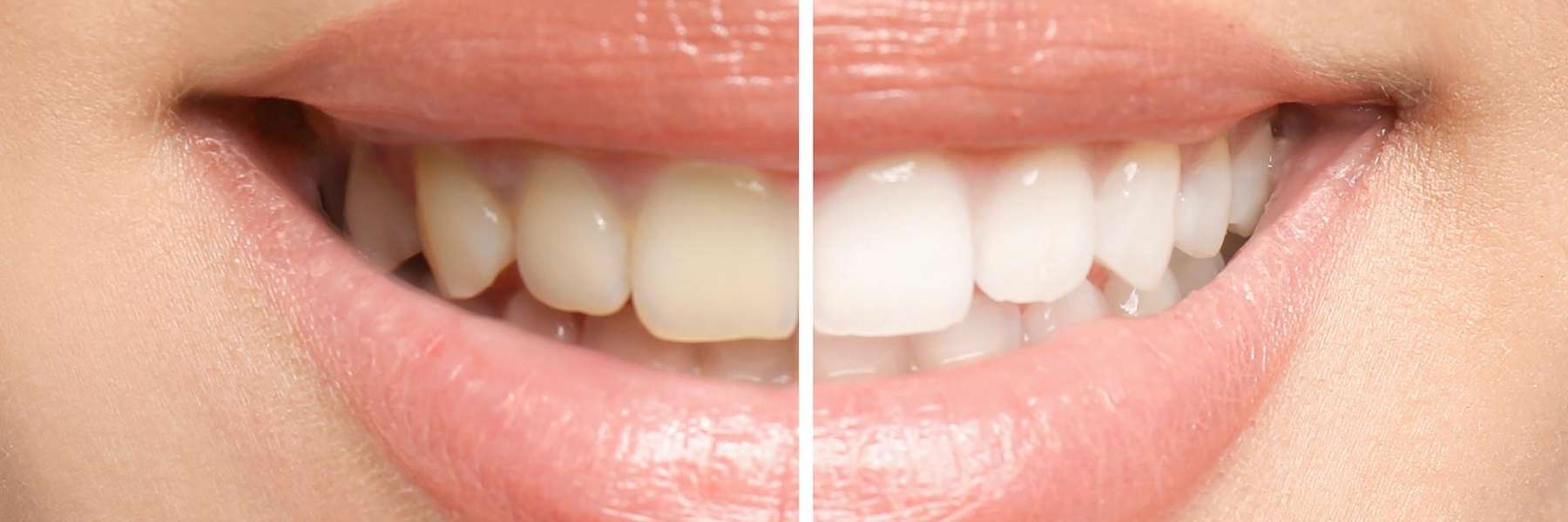 Before and after of teeth whitening, lakeland fl
