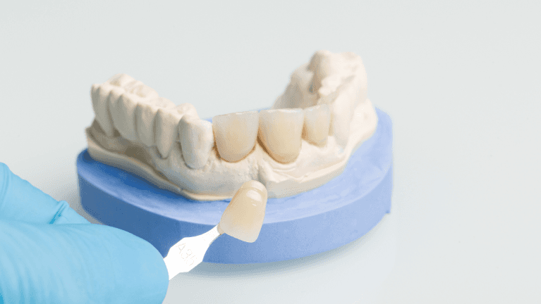 dental veneers model in Lakeland