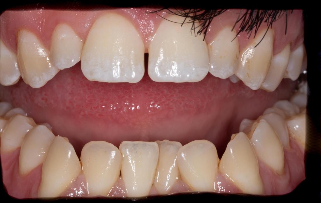 Close up of teeth after professional teeth whitening in Lakeland, FL