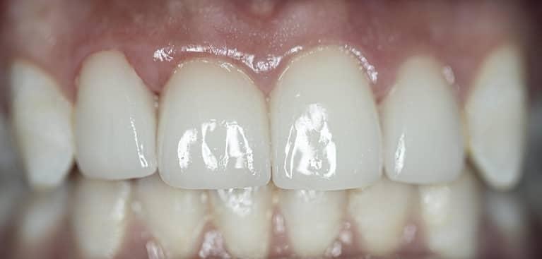 Patients teeth after dental crowns and teeth whitening in Lakeland, FL