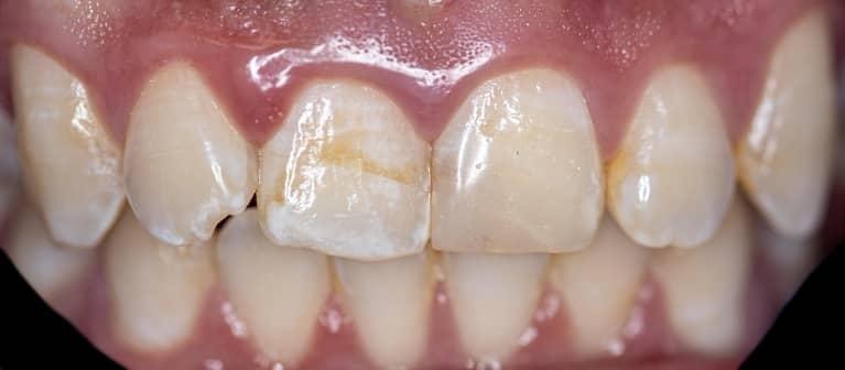 Close up of teeth before dental crowns and whitening in Lakeland FL