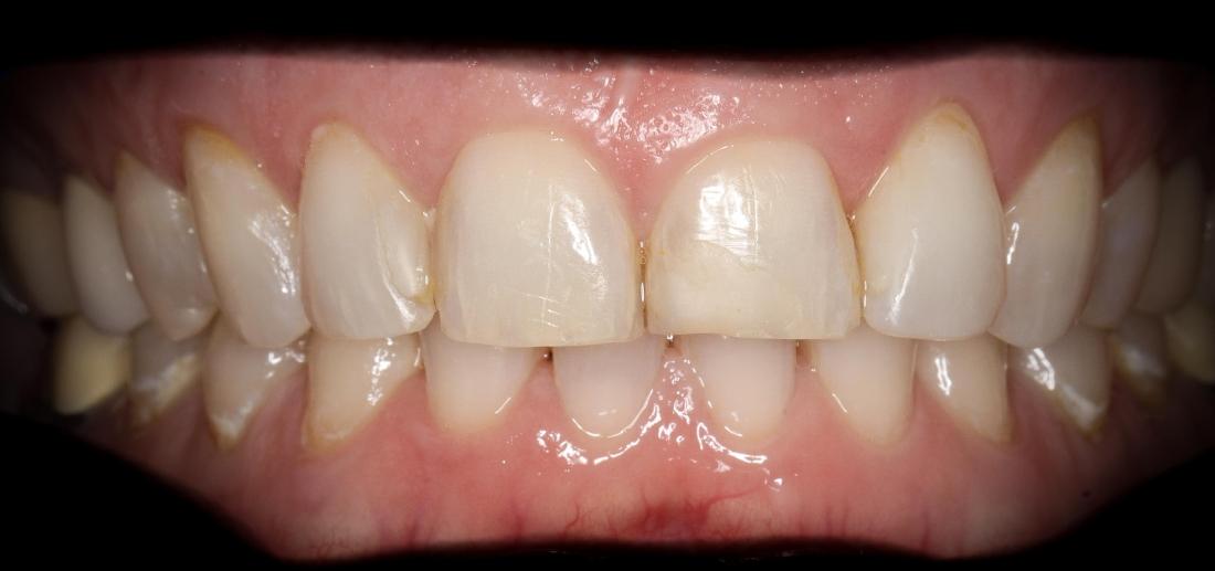 Patients teeth before crowns in Lakeland