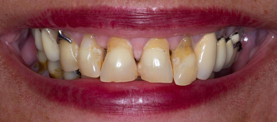 Close up of teeth before dental crowns in Lakeland