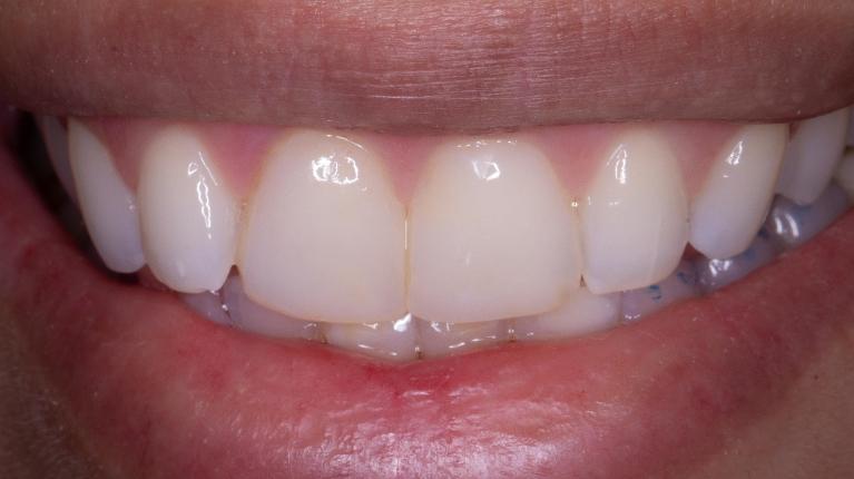 Before-and-After-Composite-Veneers-in-Lakeland-FL-After-Image