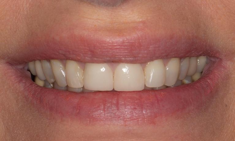 Teeth after dental crowns procedure in Lakeland
