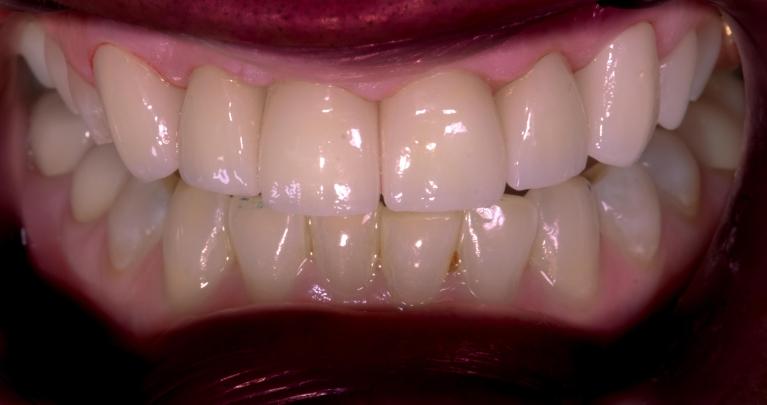 Teeth after six dental crowns in Lakeland, FL