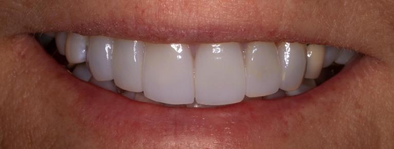 After crowns in lakeland fl