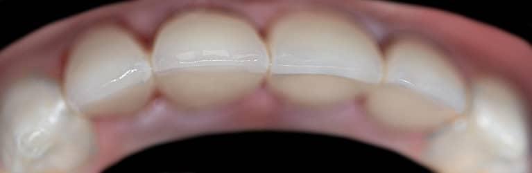Aligned teeth after dental crowns and whitening in Lakeland, FL