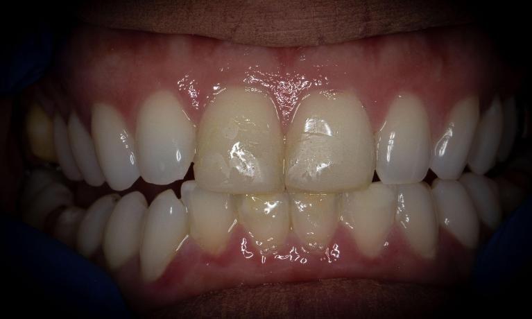 Before-and-After-Composite-Veneers-in-Lakeland-FL-Before-Image