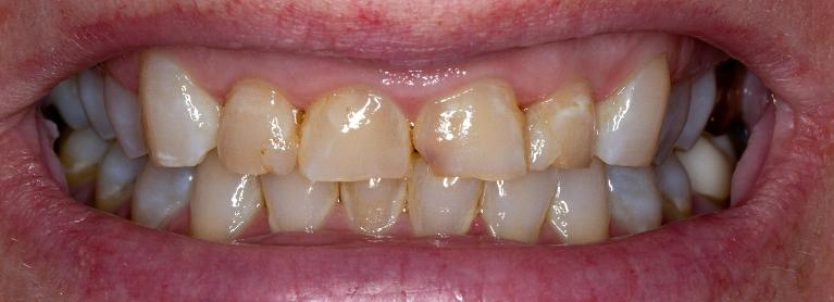 Patients teeth before crown procedure in Lakeland, FL