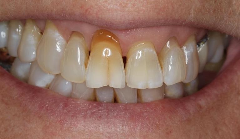 Before crowns in Lakeland fl