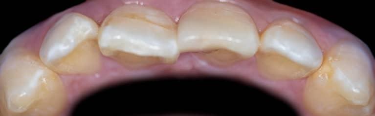 Misaligned teeth before dental crowns in Lakeland, FL